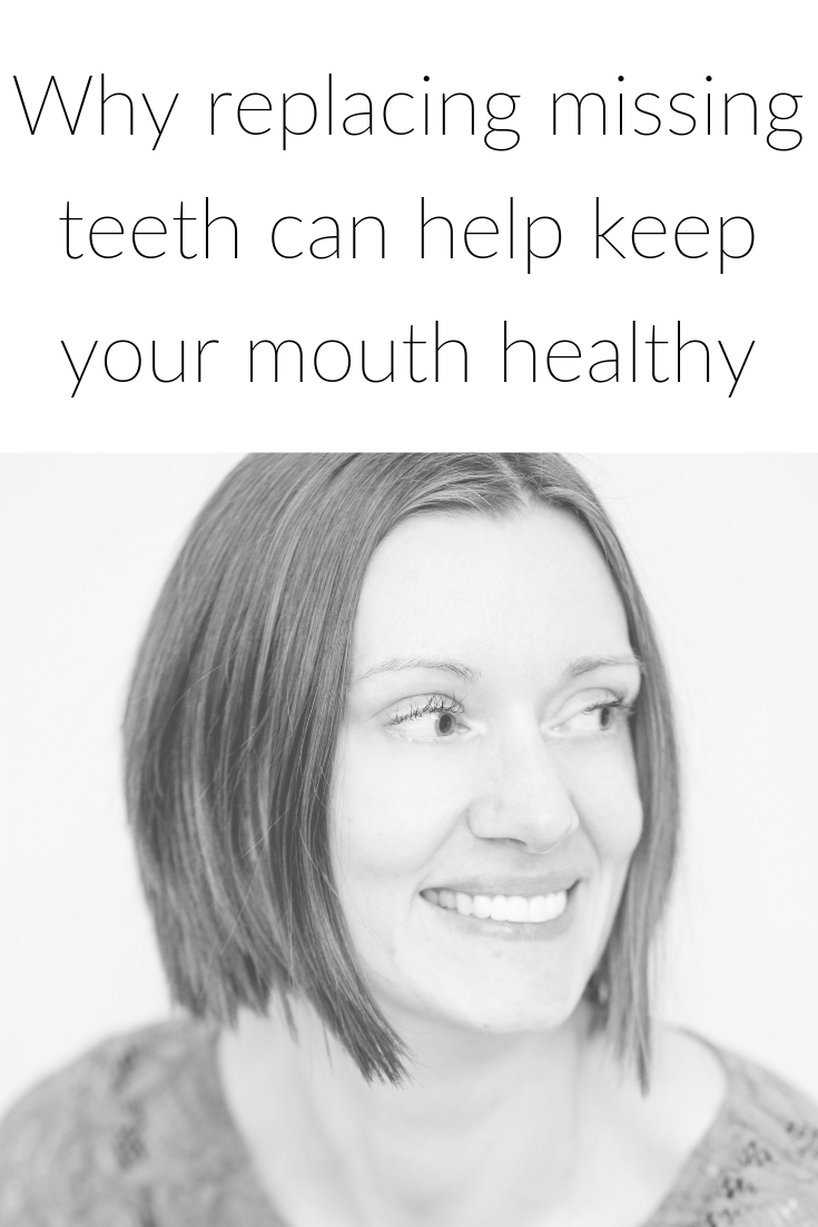 Why replacing missing teeth can help keep your mouth healthy.png