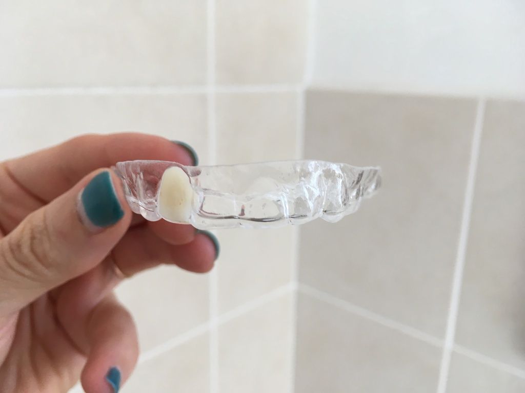Clear Essix retainer with false tooth