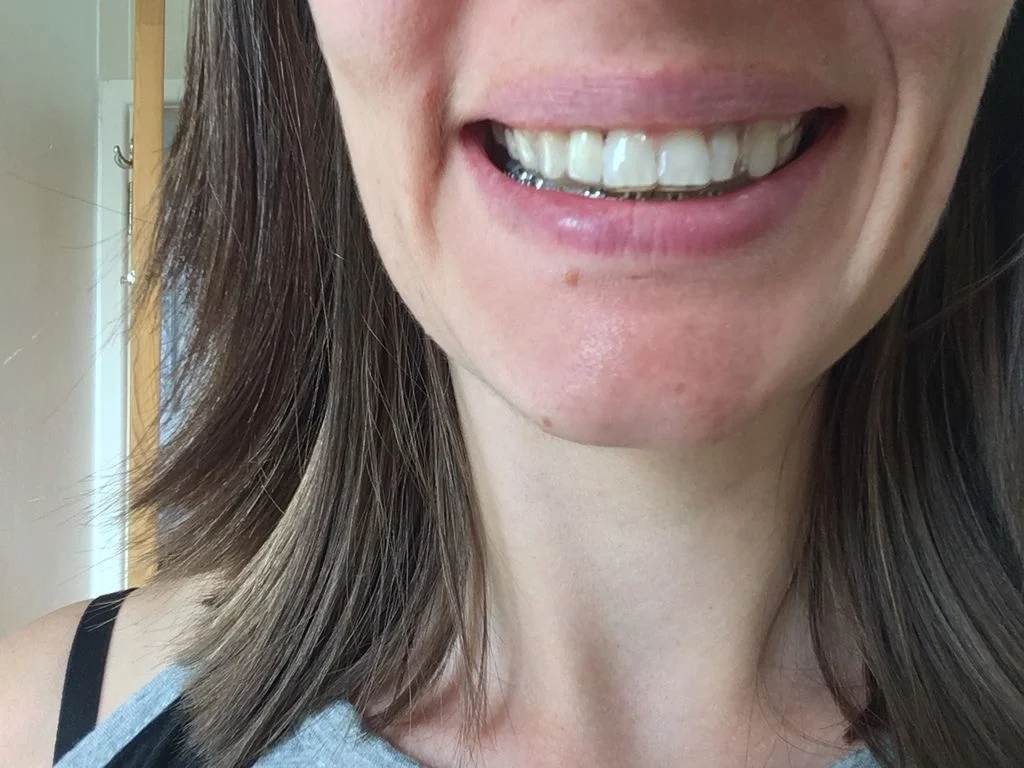 adult Essix retainer after braces removed with temporary false tooth