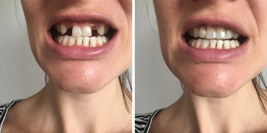 adult teeth after braces removed with missing lateral incisors - with and without Essix retainer