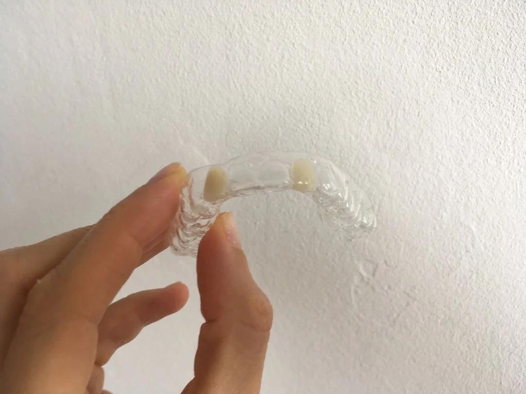 clear Essix retainer with two false lateral incisor teeth after adult braces removed