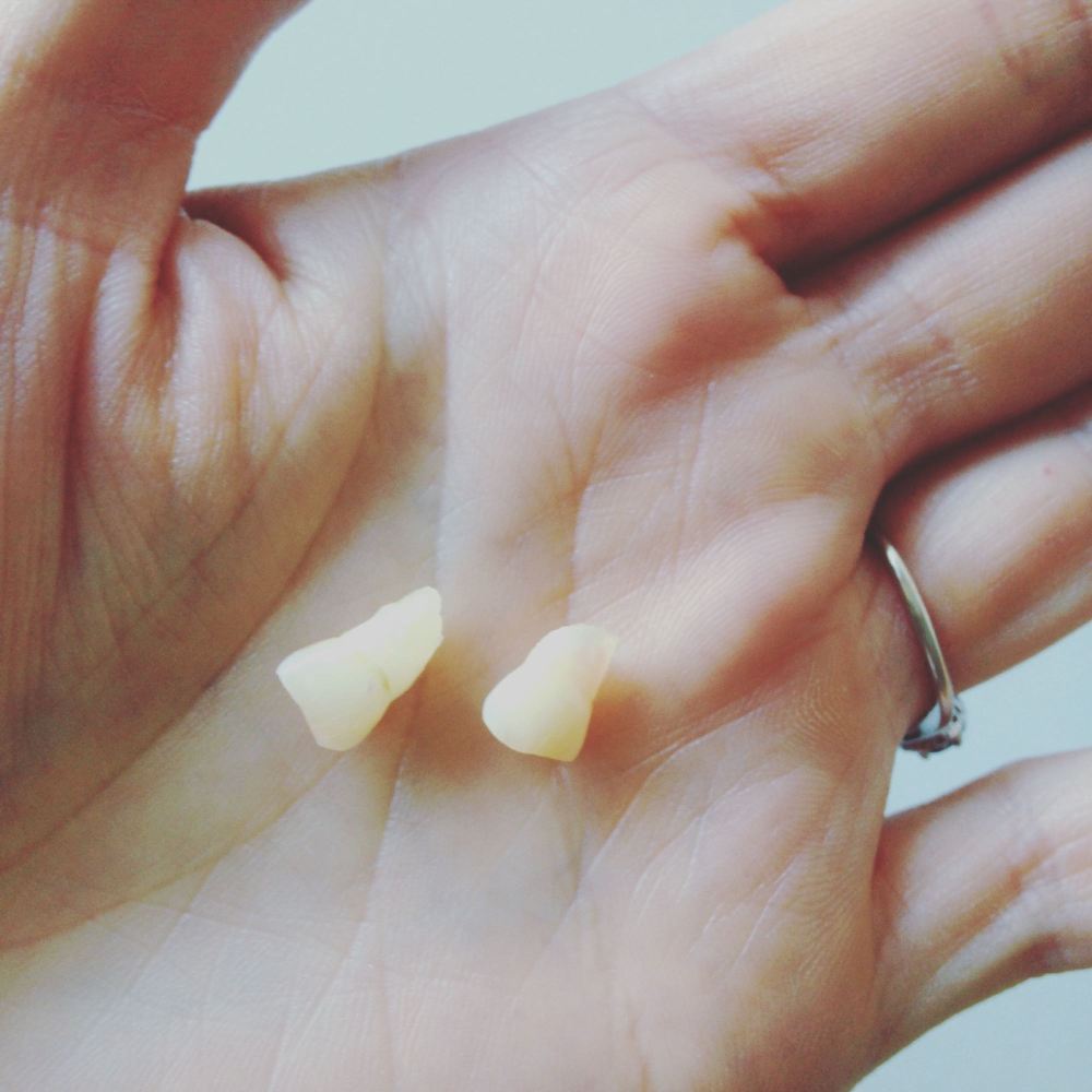 Two baby teeth removed in preparation for adult braces at age 30