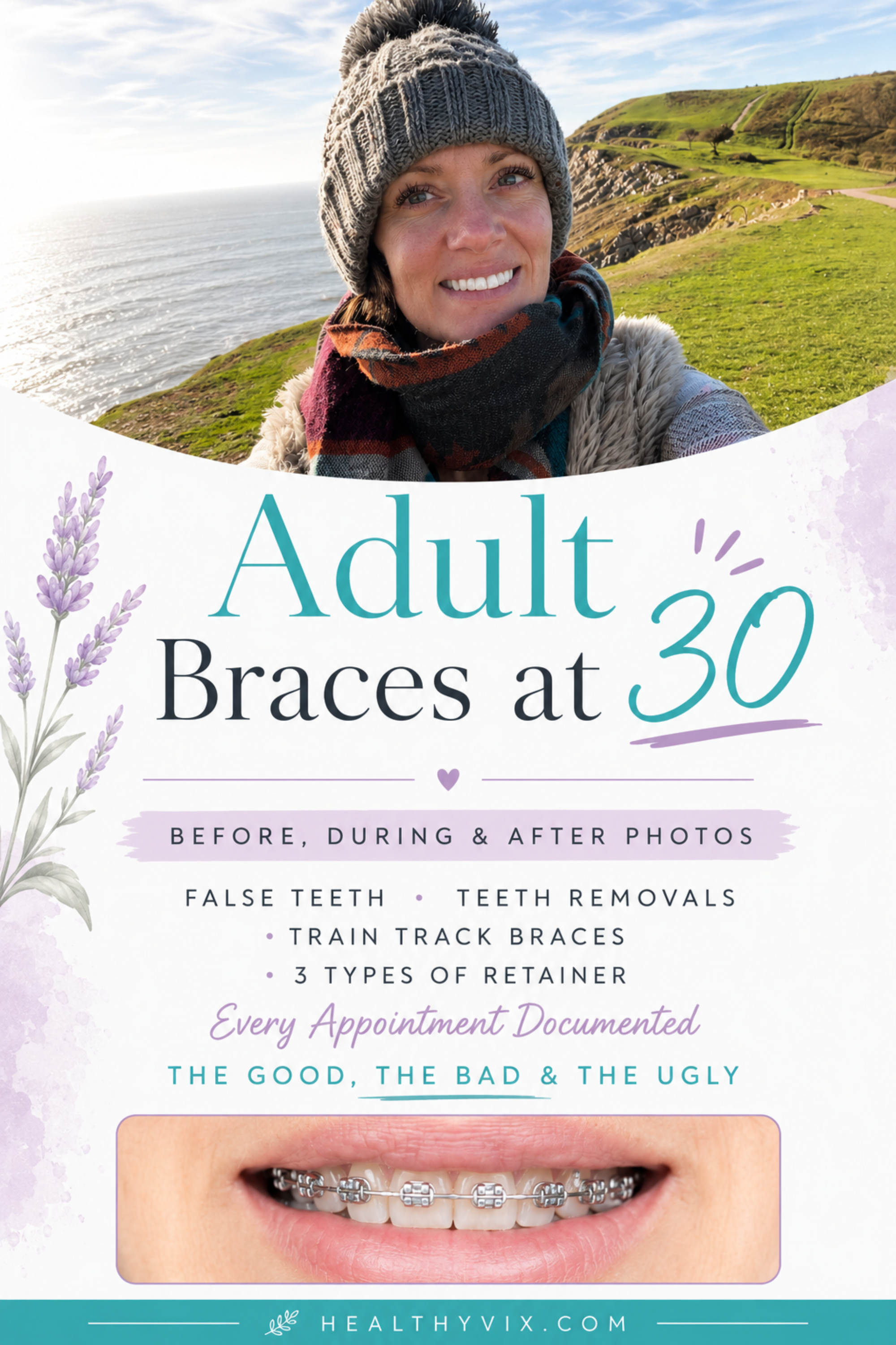 My Adult Braces Journey at 30 Before and After Photos, Every Appointment and the Honest Truth About the Experience